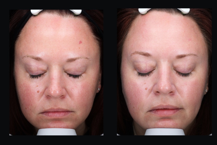 BBL face treatment, before and after