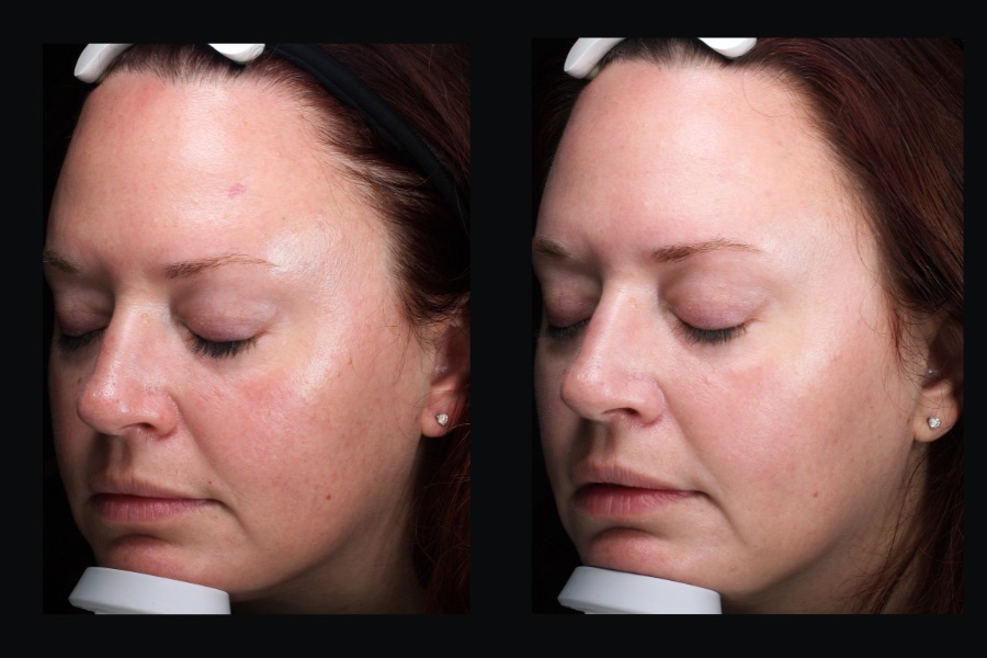 BBL face treatment, before and after