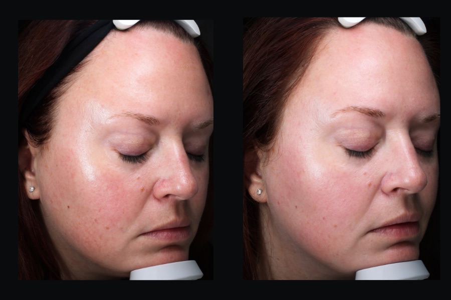 BBL face treatment, before and after