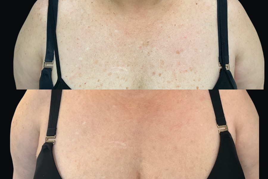 BBL and HALO chest treatment, before and after