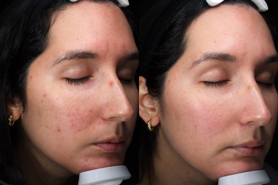 BBL and MOXI face treatment, before and after