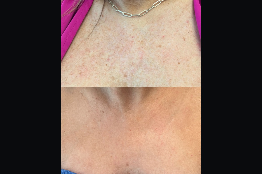 BBL and MOXI chest treatment, before and after