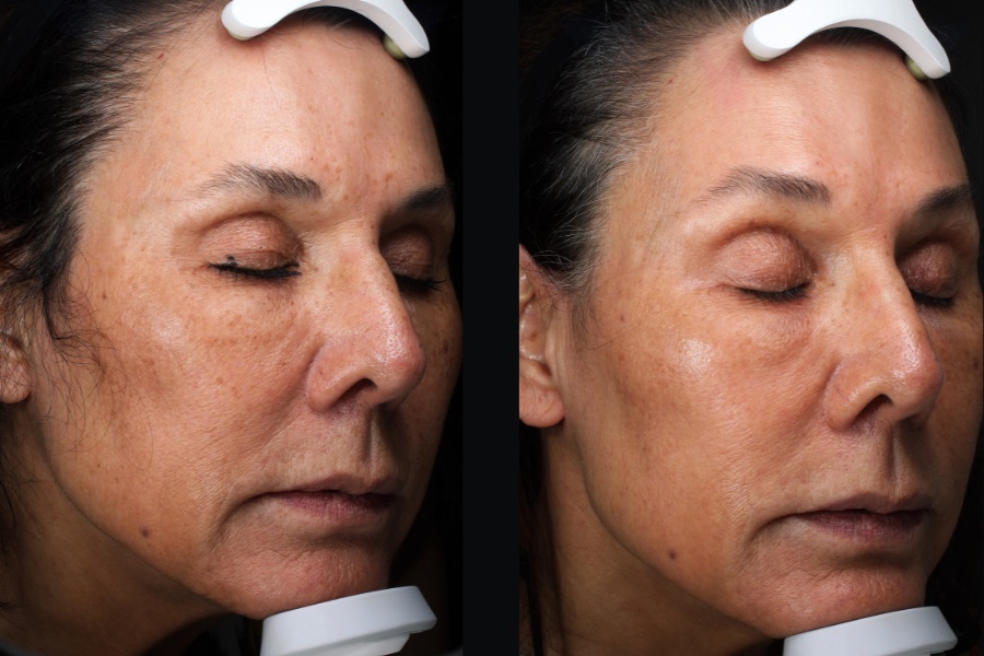 BBL and MOXI face treatment, before and after