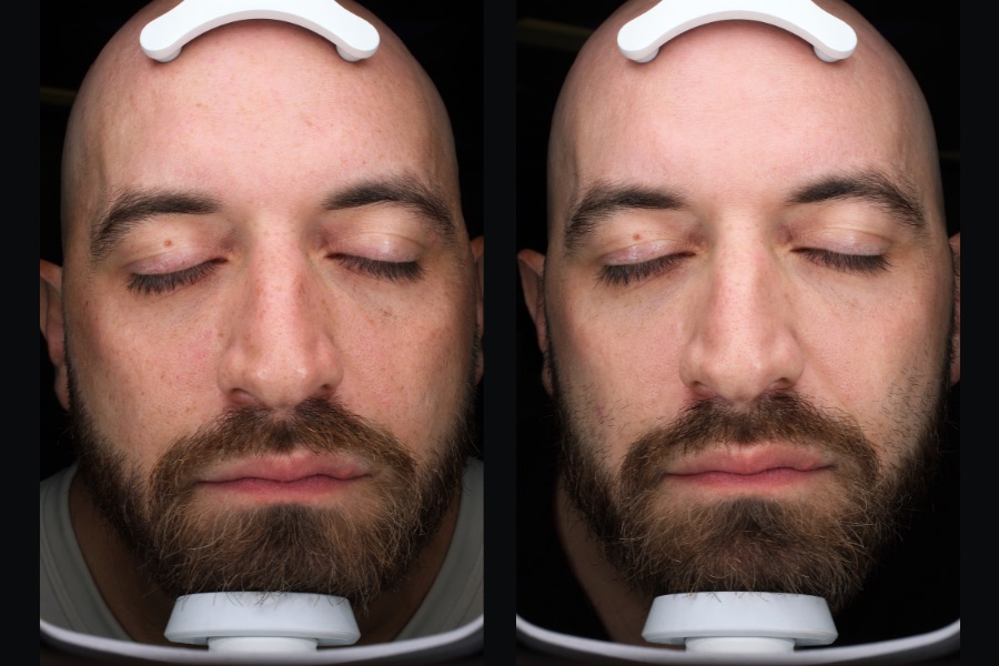 BBL and MOXI face treatment, before and after