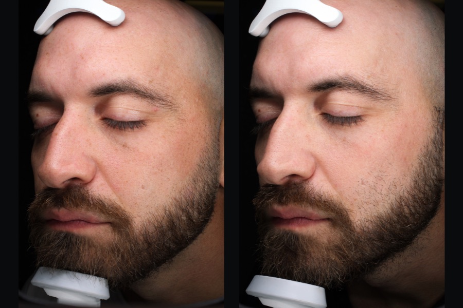 BBL and MOXI face treatment, before and after