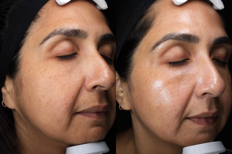 BBL and MOXI face treatment, before and after