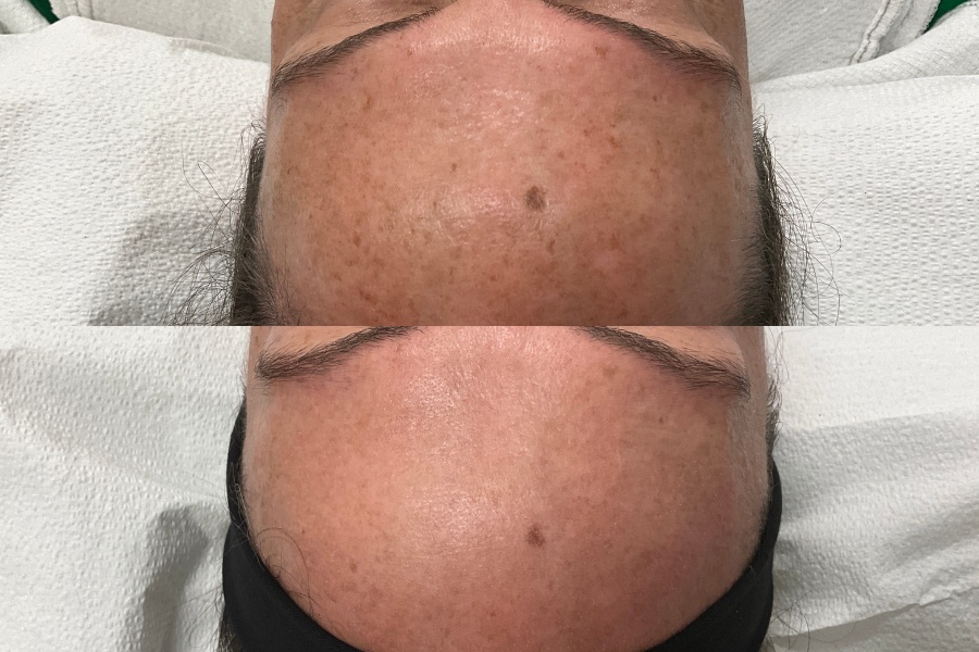 BBL after one session, before and after