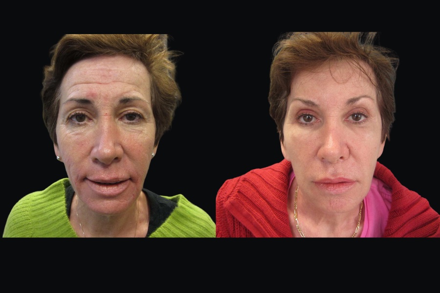 CO2 laser resurfacing, before and after
