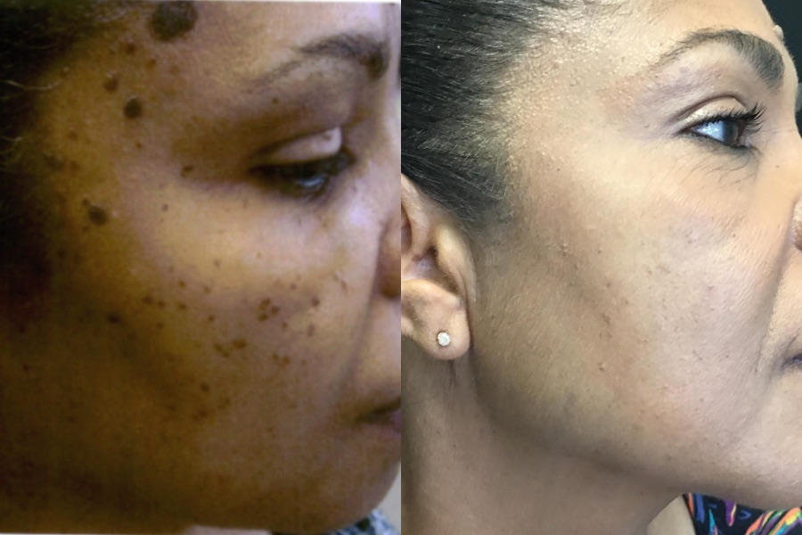CO2 laser resurfacing, before and after
