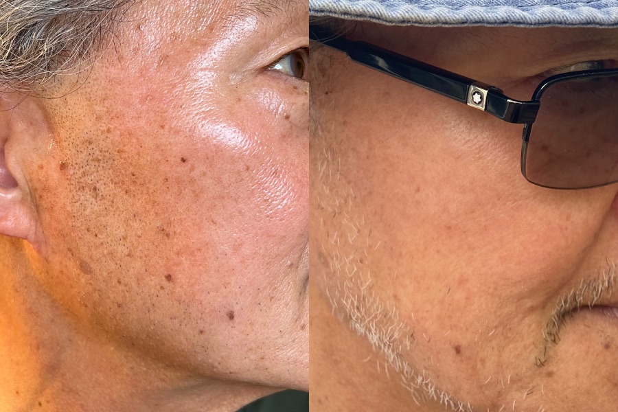 HALO laser treatment, before and after