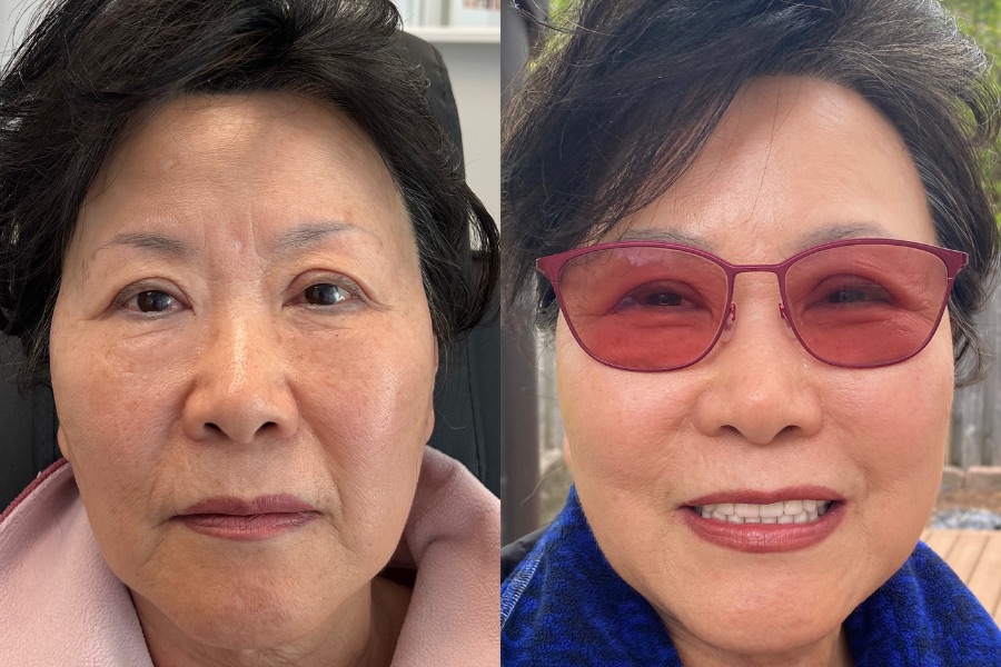 HALO laser treatment, before and after